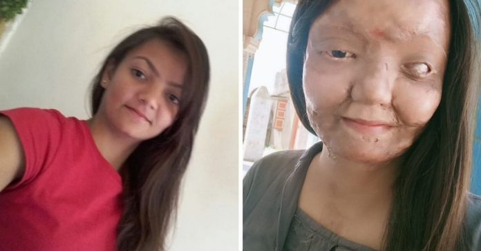 Acid Attack Renders Gujarat Girl Blind But UPSC Dreams Revived With New Vigour